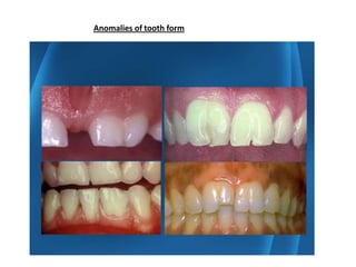 - Twin teeth (gemination/fusion)


Fusion:-
is teeth with separate pulp chambers
joined at dentin .

Gemination:-
is teeth...