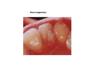 Ectopic eruption




     It occurs as a result of a
       permanent tooth bud
       malposition. Ex:-

1.     Mesial dr...