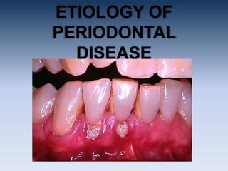 ETIOLOGY OF
PERIODONTAL
  DISEASE
 