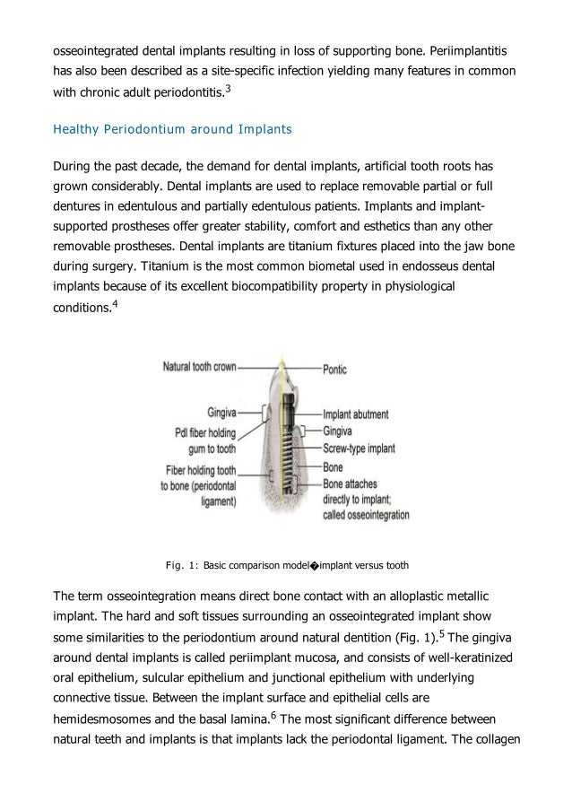 peri implantitis
