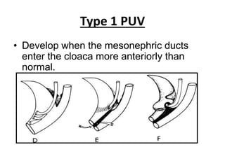 Etiopathogenesis, Evaluation & Management of Posterior Urethral Valve ...
