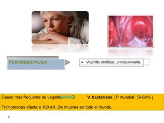 POSTMENOPAUSIA ● Vaginitis atróficas, principalmente. 
Causa más frecuente de vaginitis V. bacteriana ( P mundial: 50-60% ). 
Trichomonas afecta a 180 mil. De mujeres en todo el mundo. 
