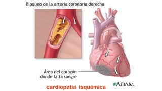 cardiopatía isquémica
 