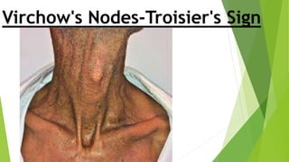 Toisier Sign CARCINOMA STOMACH AETIOLOGY,CLASSIFICATION & CLINICAL FEATURES BY JOSE ...