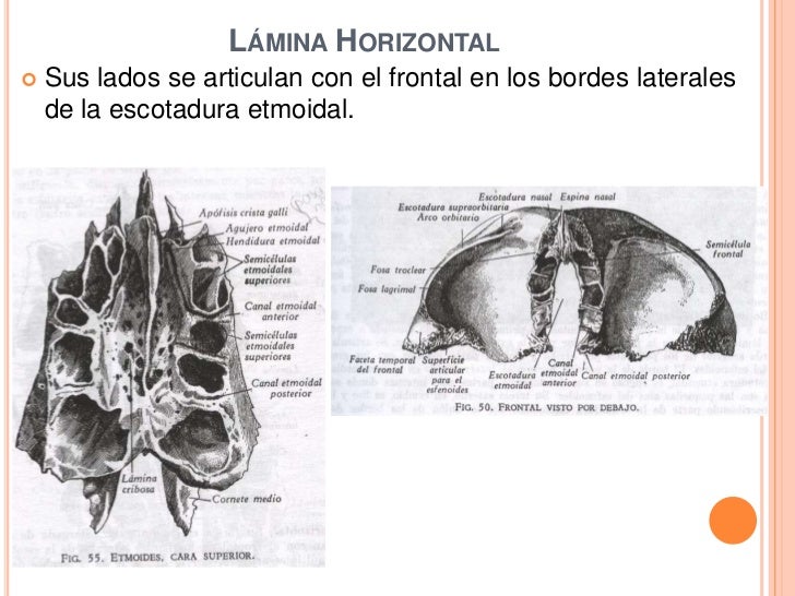 Lamina Horizontal Del Etmoides Abstractor Lamina Horizontal Del Etmoides Abstractor