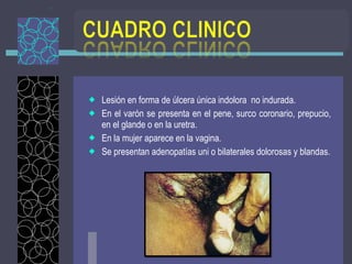 Lesión en forma de úlcera única indolora  no indurada. En el varón se presenta en el pene, surco coronario, prepucio, en el glande o en la uretra. En la mujer aparece en la vagina. Se presentan adenopatías uni o bilaterales dolorosas y blandas. 