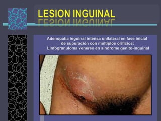 Adenopatía inguinal intensa unilateral en fase inicial  de supuración con múltiplos orificios: Linfogranuloma venéreo en síndrome genito-inguinal 