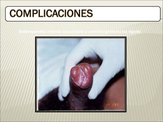 Balanopostite intensa secundaria a uretritis gonocócica aguda 