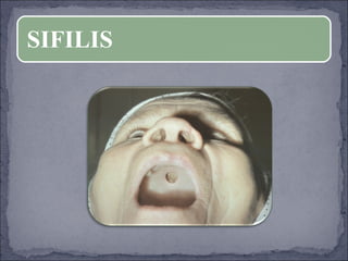 SIFILIS 