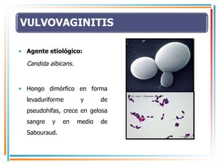 Agente etiológico: Candida albicans. Hongo dimórfico en forma levaduriforme y de pseudohifas, crece en gelosa sangre y en medio de Sabouraud.  