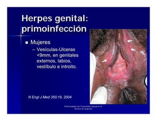 Herpes genital:
primoinfección
  Mujeres
   – Vesículas-Ulceras
     <9mm, en genitales
     externos, labios,
     vestíbulo e introito.




 N Engl J Med 350;19, 2004

                     Enfermedades de Transmisión Sexual en el
                              Servicio de Urgencia
 