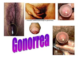 Gonorrea 