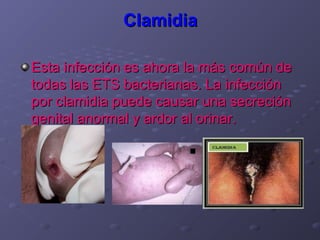 Clamidia

Esta infección es ahora la más común de
todas las ETS bacterianas. La infección
por clamidia puede causar una secreción
genital anormal y ardor al orinar.
 