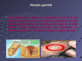 Herpes genital


La infección por herpes es causada por el virus del
herpes simplex (VHS). Los síntomas principales de una
infección por herpes son ampollas dolorosas en el área
genital. Estas pueden provocar una sensación de
comezón o picor en las piernas, nalgas o región genital
 