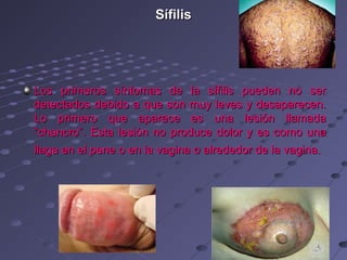 Sífilis




Los primeros síntomas de la sífilis pueden no ser
detectados debido a que son muy leves y desaparecen.
Lo primero que aparece es una lesión llamada
“chancro”. Esta lesión no produce dolor y es como una
llaga en el pene o en la vagina o alrededor de la vagina.
 