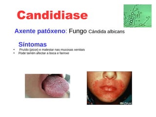 Candidiase
Axente patóxeno: Fungo Cándida albicans
Síntomas
●
Pruído (picor) e malestar nas mucosas xenitais
●
Pode tamén afectar a boca e farinxe
 