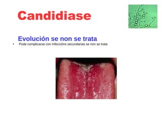 Candidiase
Evolución se non se trata
●
Pode complicarse con infeccións secundarias se non se trata
 
