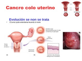 Cancro colo uterino
Evolución se non se trata
●
O tumor pode extenderse levando á morte
 