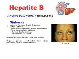 Hepatite B
Axente patóxeno: Virus hepatite B
Síntomas
●
Aparecen 4 semanas despois do contaxio
●
Mulleres e homes
- Fatiga extrema, dor cabeza, febre e malestar xeral
- Perda apetito, naúseas e vómitos
- Ictericia (pel e ollos amarelos)
- Oscurecemento dos ouriños
Os síntomas desaparecen despois de 4 – 8 semanas
Nalgunhas persoas a enfermidade faise crónica
presentando síntomas durante toda a vida. ICTERICIA
 