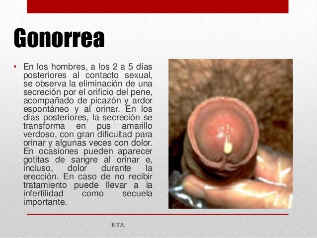 Como aumentar el miembro por medio de las cargas