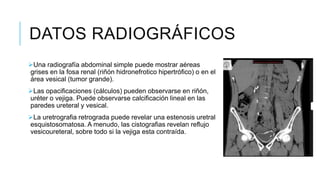 DATOS RADIOGRÁFICOS
Una radiografía abdominal simple puede mostrar aéreas
grises en la fosa renal (riñón hidronefrotico hipertrófico) o en el
área vesical (tumor grande).
Las opacificaciones (cálculos) pueden observarse en riñón,
uréter o vejiga. Puede observarse calcificación lineal en las
paredes ureteral y vesical.
La uretrografia retrograda puede revelar una estenosis uretral
esquistosomatosa. A menudo, las cistografias revelan reflujo
vesicoureteral, sobre todo si la vejiga esta contraída.
 