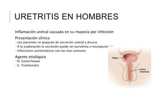 URETRITIS EN HOMBRES
Inflamación uretral causada en su mayoría por infección
Presentación clínica
 Los pacientes se quejarán de secreción uretral y disuria
 A la exploración la secreción puede ser purulenta o mucopurulenta
 Infecciones asintomáticas son las mas comunes
Agente etiológico
 N. Gonorrhoeae
 C. Trachomatis
 