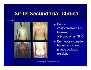 Sífilis Secundaria: Clínica
                                             Puede
                                             comprometer: Ojos,
                                             Huesos,
                                             articulaciones, SNC.
                                             En mucosas pueden
                                             haber condilomas
                                             planos o placas
                                             erosivas.

         Enfermedades de Transmisión Sexual en el
                  Servicio de Urgencia
 