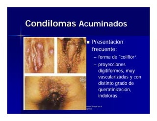 Condilomas Acuminados
                                     Presentación
                                     frecuente:
                                       – forma de "coliflor“
                                       – proyecciones
                                         digitiformes, muy
                                         vascularizadas y con
                                         distinto grado de
                                         queratinización,
                                         indoloras.

        Enfermedades de Transmisión Sexual en el
                 Servicio de Urgencia
 