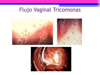 Flujo Vaginal Tricomonas 