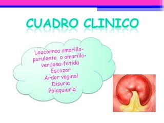 Leucorrea amarillo-purulenta  o amarillo-verdosa-fetida Escozor Ardor vaginal Disuria  Polaquiuria 