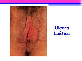 Ulcera Luética 