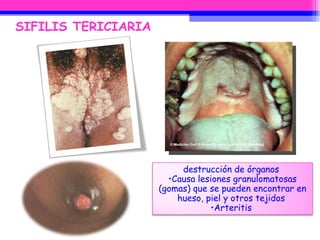 SIFILIS TERICIARIA destrucción de órganos  Causa lesiones granulomatosas (gomas) que se pueden encontrar en hueso, piel y otros tejidos  Arteritis  