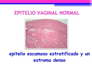 EPITELIO VAGINAL NORMAL epitelio escamoso estratificado y un estroma denso 