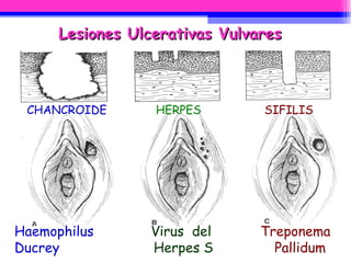 CHANCROIDE   HERPES   SIFILIS Haemophilus  Virus  del   Treponema  Ducrey  Herpes S  Pallidum Lesiones Ulcerativas Vulvares 