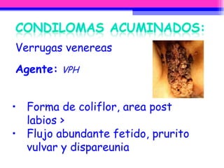 Verrugas venereas Agente:   VPH Forma de coliflor, area post labios > Flujo abundante fetido, prurito vulvar y dispareunia 