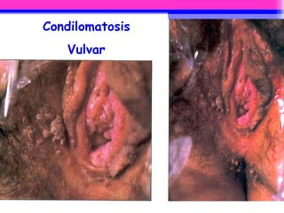Condilomatosis Vulvar 
