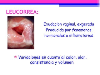 LEUCORREA: Exudacion vaginal, exgerada Producida por fenomenos hormonales e inflamatorios Variaciones en cuanto al color, olor, consistencia y volumen  