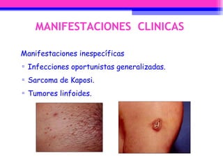 MANIFESTACIONES  CLINICAS Manifestaciones inespecíficas Infecciones oportunistas generalizadas. Sarcoma de Kaposi. Tumores linfoides. 