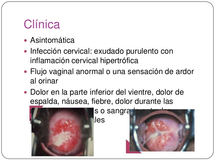 Ets vulvovaginitis uretritis y cervicitis Ets vulvovaginitis uretritis y cervicitis