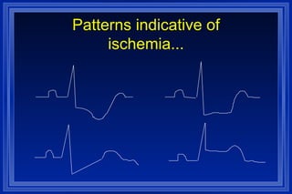 Patterns indicative of ischemia... 