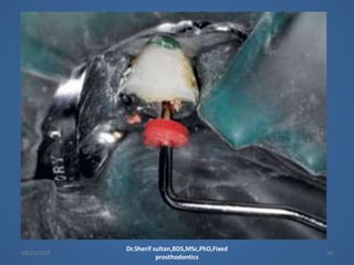 restoration of endodontically treated teeth cast post | PPTX