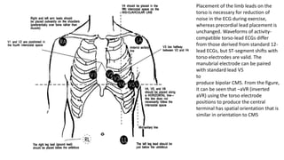 Placement of the limb leads on the
torso is necessary for reduction of
noise in the ECG during exercise,
whereas precordial lead placement is
unchanged. Waveforms of activity-
compatible torso-lead ECGs differ
from those derived from standard 12-
lead ECGs, but ST-segment shifts with
torso electrodes are valid. The
manubrial electrode can be paired
with standard lead V5
to
produce bipolar CM5. From the figure,
it can be seen that –aVR (inverted
aVR) using the torso electrode
positions to produce the central
terminal has spatial orientation that is
similar in orientation to CM5
 