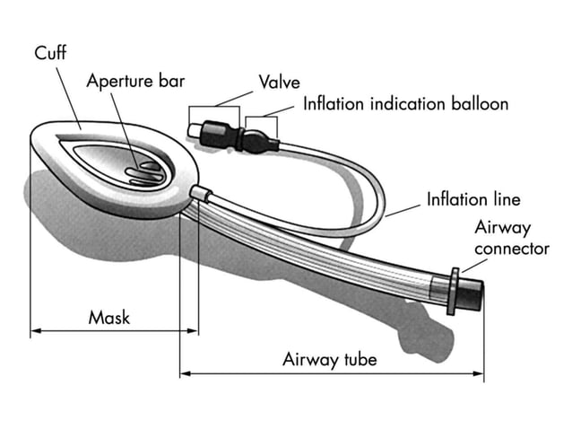 Endotracheal Tube and Laryngeal Mask Airway | PPTX