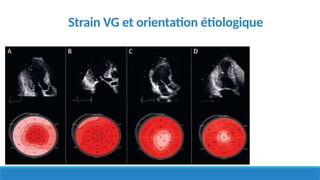 Strain VG et orientation étiologique
 