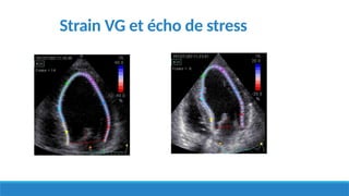 Strain VG et écho de stress
 