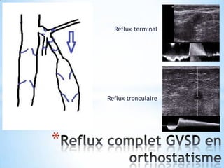 Reflux terminal




    Reflux tronculaire




*
 