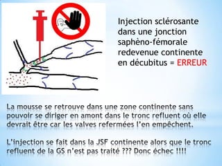 Injection sclérosante
dans une jonction
saphèno-fémorale
redevenue continente
en décubitus = ERREUR
 