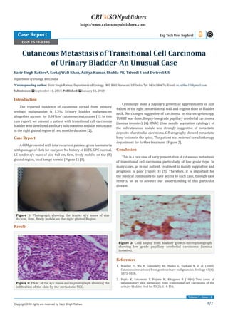 1/2
Volume 1 - Issue - 2
Introduction
The reported incidence of cutaneous spread from primary
urologic malignancies is 1.3%. Urinary bladder malignancies
altogether account for 0.84% of cutaneous metastases [1]. In this
case report, we present a patient with transitional cell carcinoma
bladder who developed a solitary subcutaneous nodular metastasis
in the right gluteal region of two months duration [2].
Case Report
A 60M presented with total recurrent painless gross haematuria
with passage of clots for one year. No history of LUTS. GPE-normal.
LE-tender s/c mass of size 4x3 cm, firm, freely mobile, on the (R)
gluteal region, local tempt normal (Figure 1) [3].
Figure 1: Photograph showing the tender s/c mass of size
4x3cm, firm, freely mobile,on the right gluteal Region.
Results
Figure 2: FNAC of the s/c mass-micro photograph showing the
infiltration of the skin by the metastatic TCC.
Cystoscopy done a papillary growth of approximately of size
4x3cm in the right posterolateral wall and trigone close to bladder
neck. No changes suggestive of carcinoma in situ on cystoscopy.
TURBT was done. Biopsy-low grade papillary urothelial carcinoma
(lamina invasive) [4]. FNAC (fine needle aspiration cytology) of
the subcutaneous nodule was strongly suggestive of metastatic
deposits of urothelial carcinoma. C.T urography showed metastatic
bony lesions in the spine. The patient was referred to radiotherapy
department for further treatment (Figure 2).
Conclusion
This is a rare case of early presentation of cutaneous metastasis
of transitional cell carcinoma particularly of low grade type. In
many cases, as in our patient, treatment is mainly supportive and
prognosis is poor (Figure 3) [5]. Therefore, it is important for
the medical community to have access to each case, through case
reports, so as to advance our understanding of this particular
disease.
Figure 3: Cold biopsy from bladder growth-microphotograph
showing low grade papillary urothelial carcinoma (lamina
invasive).
References
1.	 Mueller TJ, Wu H, Greenberg RE, Hudes G, Topham N, et al. (2004)
Cutaneous metastases from genitourinary malignancies. Urology 63(6):
1021-1026.
2.	 Fujita K, Sakamoto Y, Fujime M, Kitagawa R (1994) Two cases of
inflammatory skin metastasis from transitional cell carcinoma of the
urinary bladder. Urol Int 53(2): 114-116.
Vazir Singh Rathee*, Sartaj Wali Khan, Aditya Kumar, Shukla PK, Trivedi S and Dwivedi US
Department of Urology, BHU, India
*Corresponding author: Vazir Singh Rathee, Department of Urology, IMS, BHU, Varanasi, UP, India, Tel: 9416380676; Email:
Submission: September 10, 2017; Published: January 11, 2018
Cutaneous Metastasis of Transitional Cell Carcinoma
of Urinary Bladder-An Unusual Case
Exp Tech Urol Nephrol
Copyright © All rights are reserved by Vazir Singh Rathee.
CRIMSONpublishers
http://www.crimsonpublishers.com
Case Report
ISSN 2578-0395
 