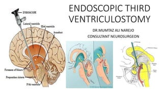 ENDOSCOPIC THIRD
VENTRICULOSTOMY
DR.MUMTAZ ALI NAREJO
CONSULTANT NEUROSURGEON
 