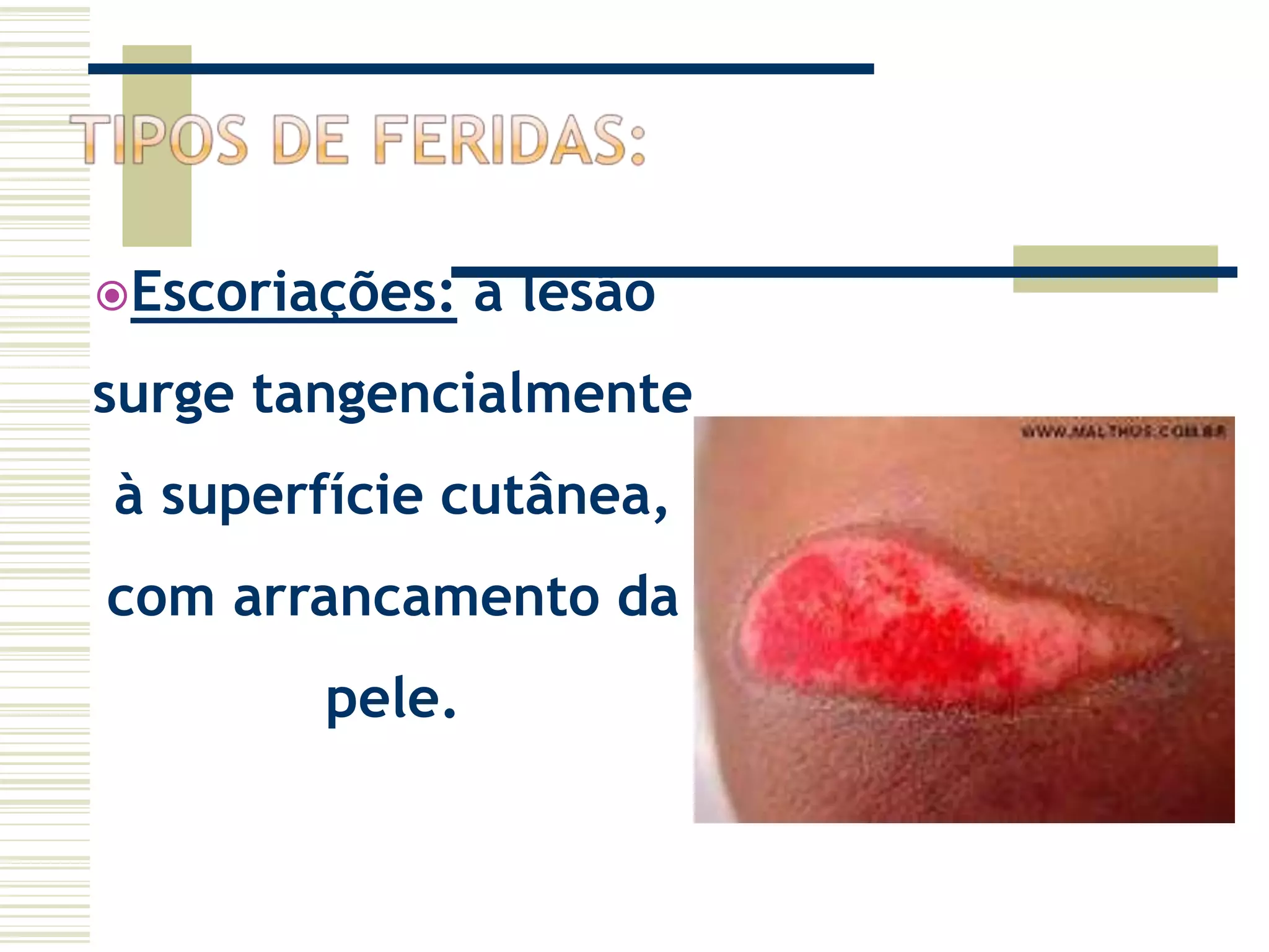 Escoriações: a lesão
surge tangencialmente
à superfície cutânea,
com arrancamento da
pele.
 